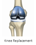 Knee Replacement final