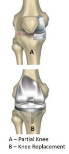 Partial knee replacement ASJI