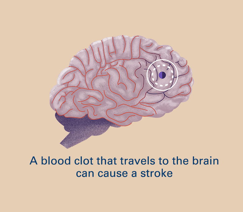 A blood clot that travels to the brain can cause a stroke